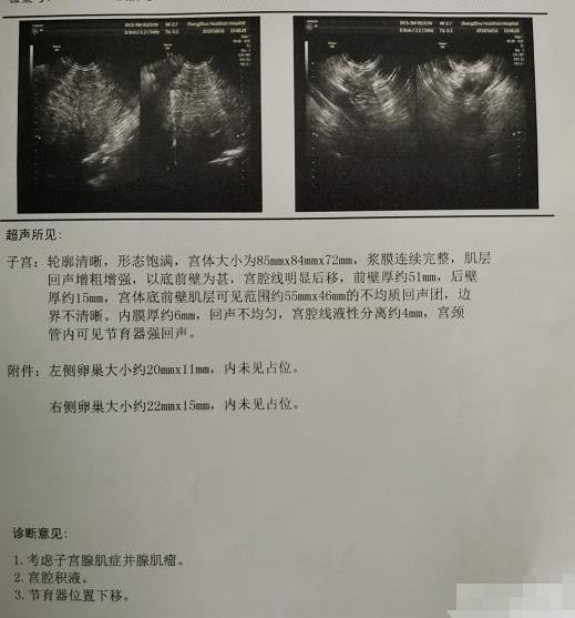 怎样从b超单子上看子宫的情况?