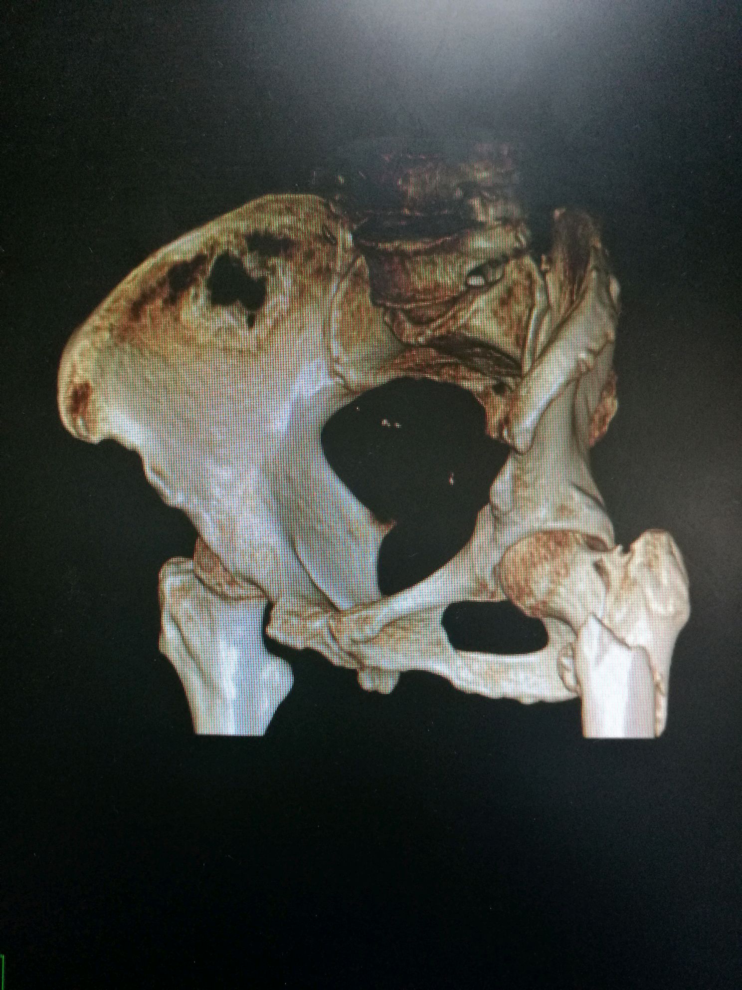老年股骨转子下骨折