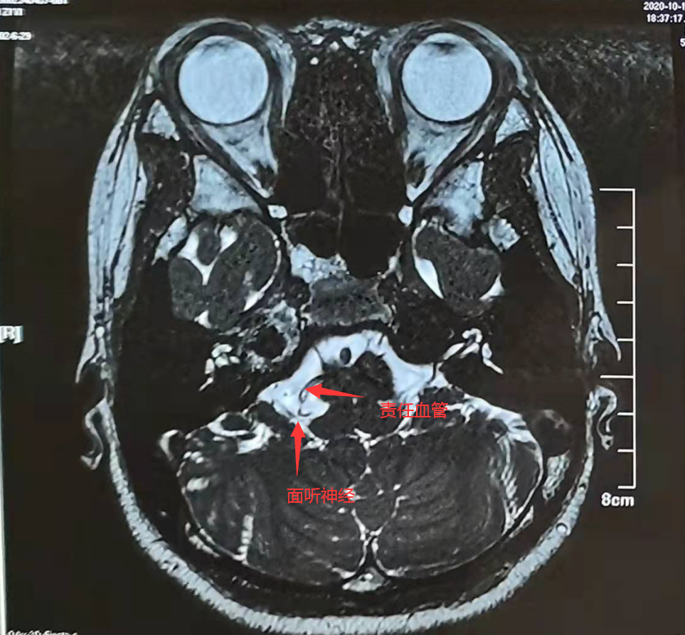 术前核磁共振检查肌电图结果mvd术解除"责任血管"压迫助她重新找回"