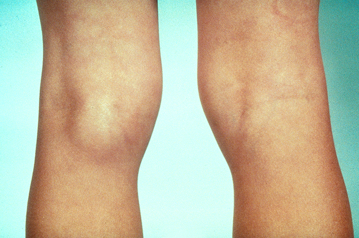 儿童腘窝囊肿(popliteal cyst 或 bakers cyst)