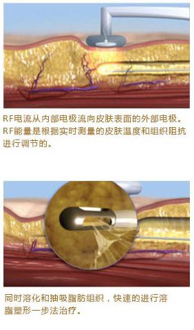 bodytite射频溶脂?bodytite射频紧肤?bodytite到底是干啥的?