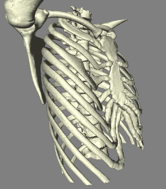 肩胛骨三维重建图片图片