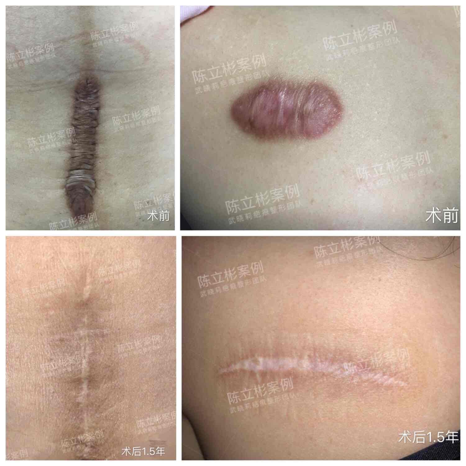 护理,近日微信随访,已逾一年半,疤痕未增生,轻度变宽,总体恢复不错