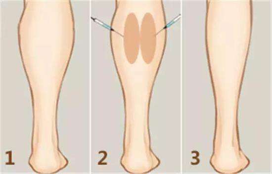 肉毒素瘦腿只针对小腿的腓肠肌肥大改善,大腿肥胖主要是脂肪堆积 所以