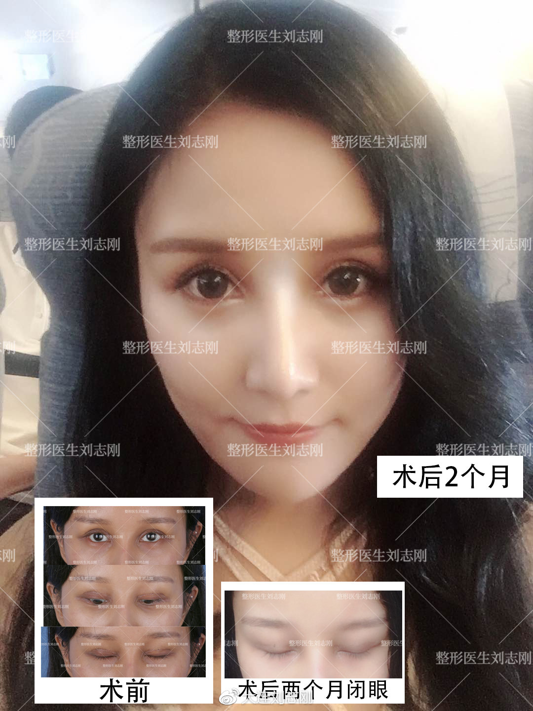 双眼皮专家任召磊和刘志刚谁双眼皮做的好 - 美妆技巧 - 整形医院排行榜