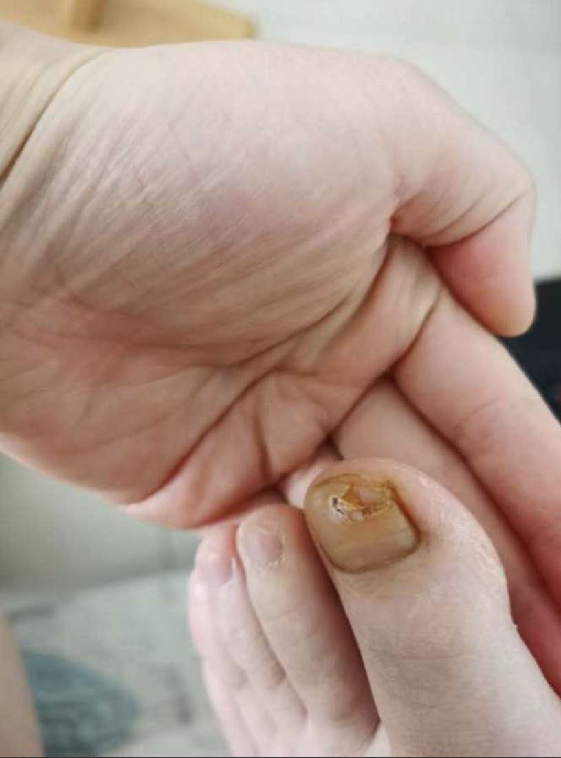 如何治疗指甲盖已经分离了露肉了