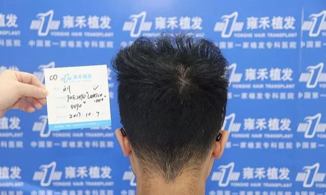 公立医院医生脱发来民营医院植发1年帅形象欢喜结婚