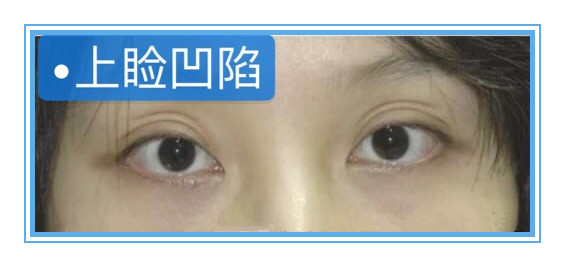 【整形医生傅荣】上睑凹陷的造成原因及治疗方法!