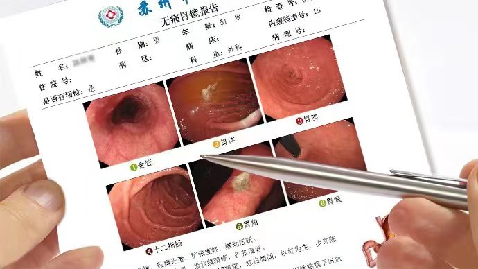 胆汁反流胃镜图片图片