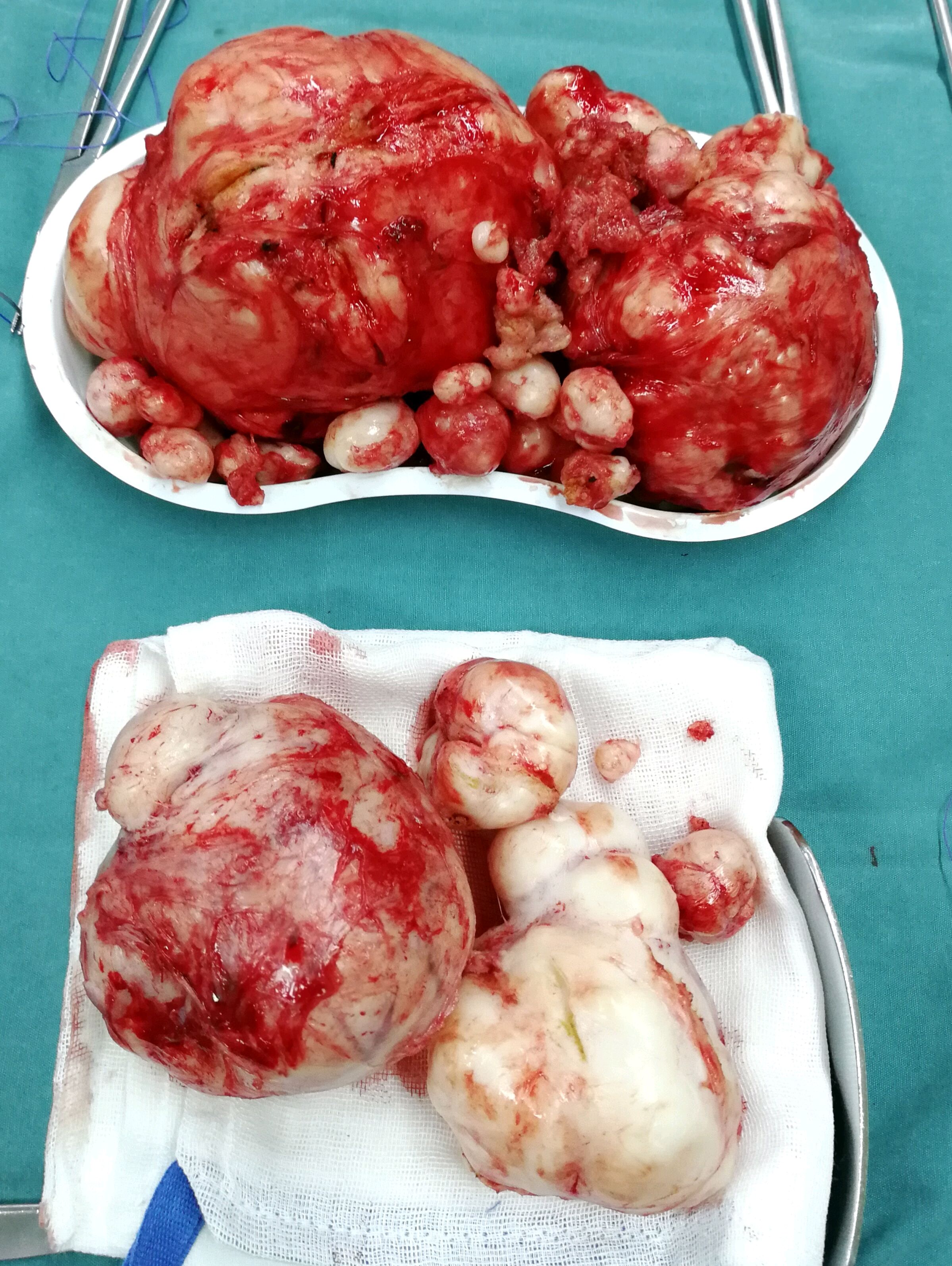 子宫肌瘤排出来的图片图片