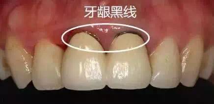 牙龈黑线问题