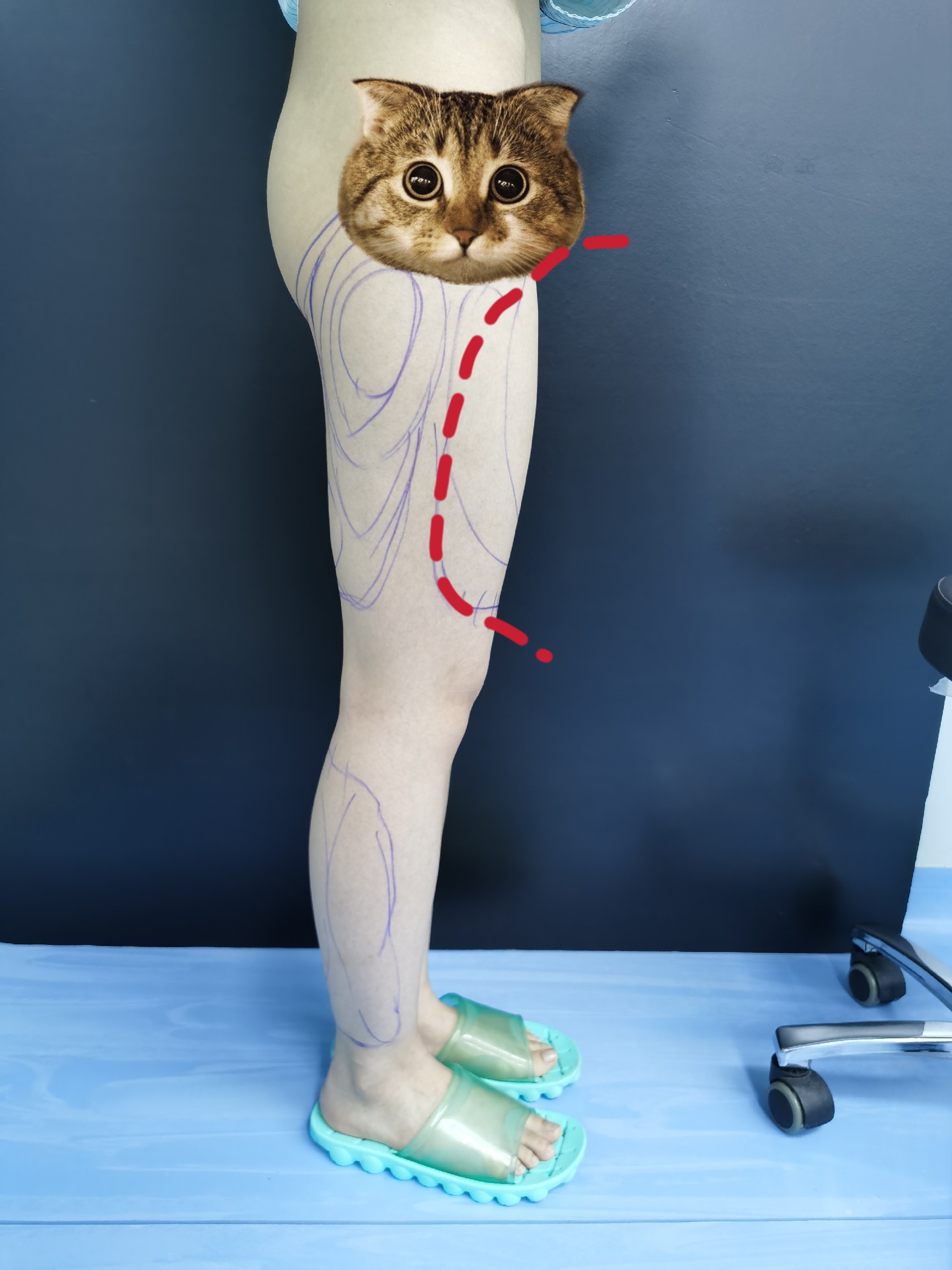 大腿吸脂哪些地方可以吸,哪些地方要注意