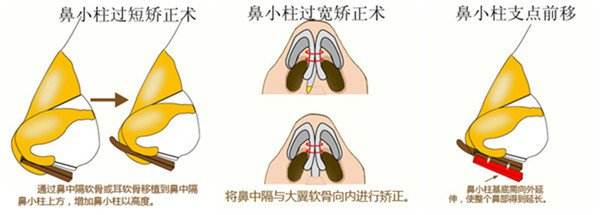鼻小柱过短矫正术鼻小柱过宽矫正术.jpg
