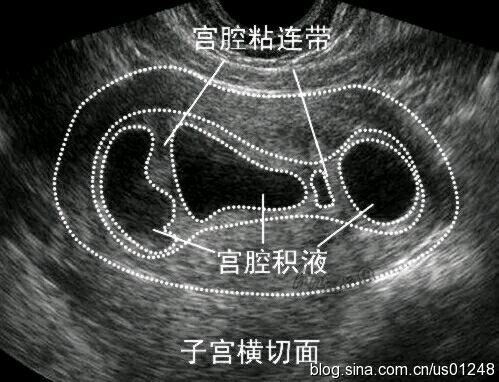 部分宫腔粘连的超声图像