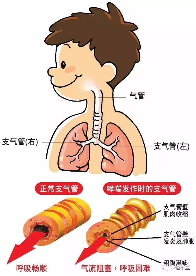 关于【哮喘,妈妈必须要知道的四件事-董德坤-爱问医生