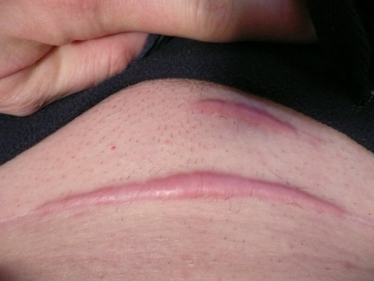 剖腹产疤痕正常图片