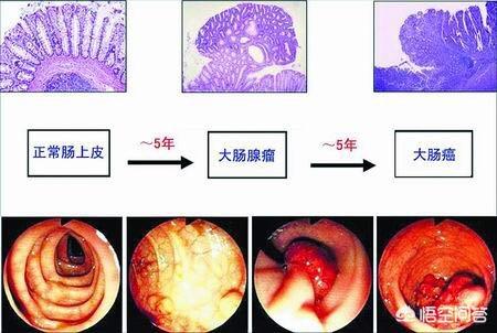 如果不切除肠息肉能活多久?