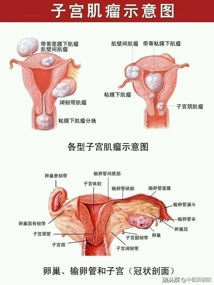 国医大师邓铁涛治疗子宫肌瘤经验方