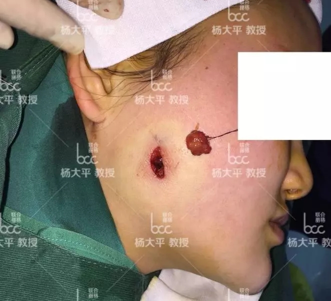 打瘦脸针后面颊双侧出现囊肿怎么办