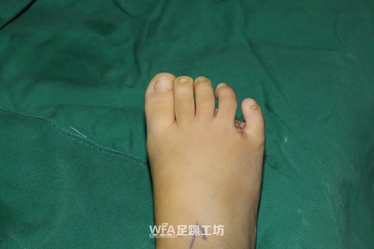唐氏儿脚趾的症状图片图片
