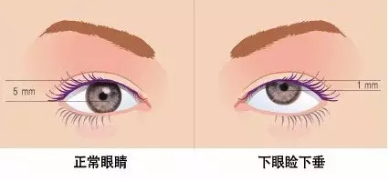 告别昏昏欲睡还你明亮眼眸