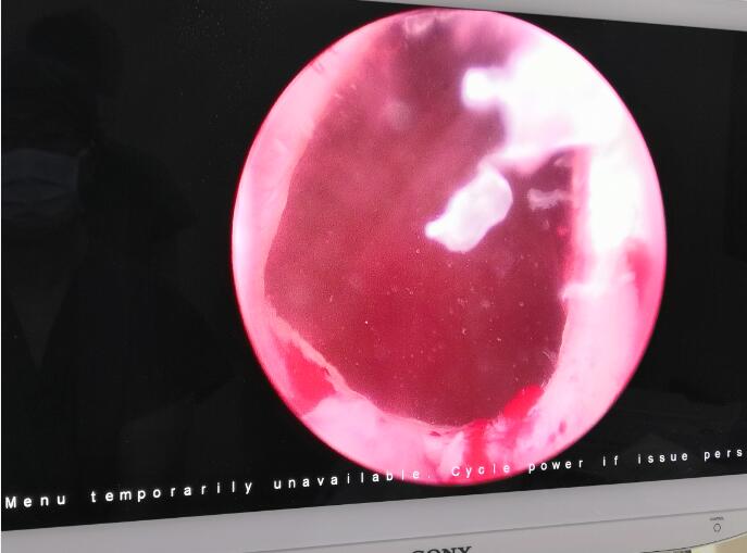 一例经尿道前列腺切除术后膀胱颈挛缩手术