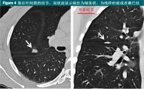 体检发现肺部结节怎么办?