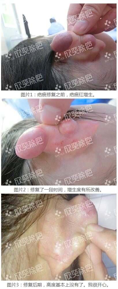 耳朵疤痕疙瘩是如何产生的要怎么预防