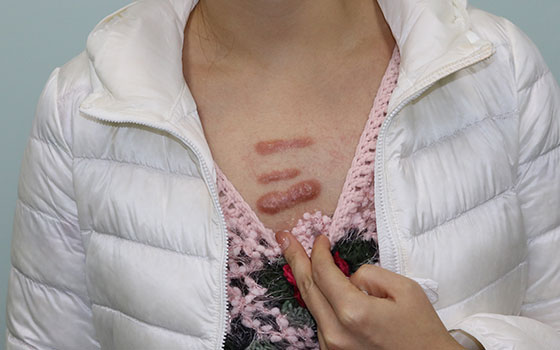 女生胸前瘢痕疙瘩图片图片