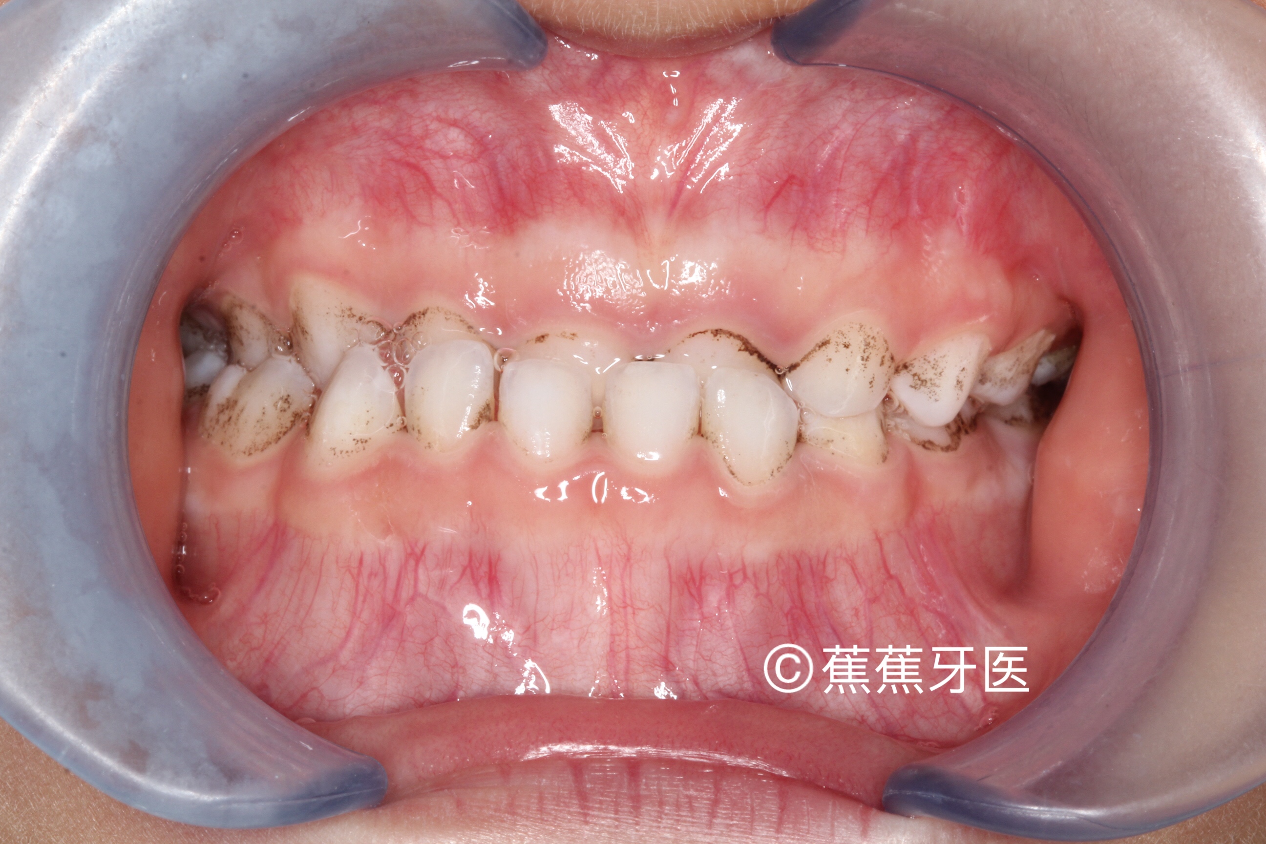 就会开始有地包天的现象,地包天实际指的是前牙反颌,正常牙齿覆合