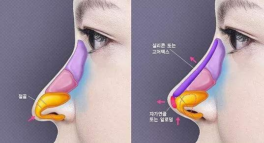 鹰钩鼻要怎么矫正?