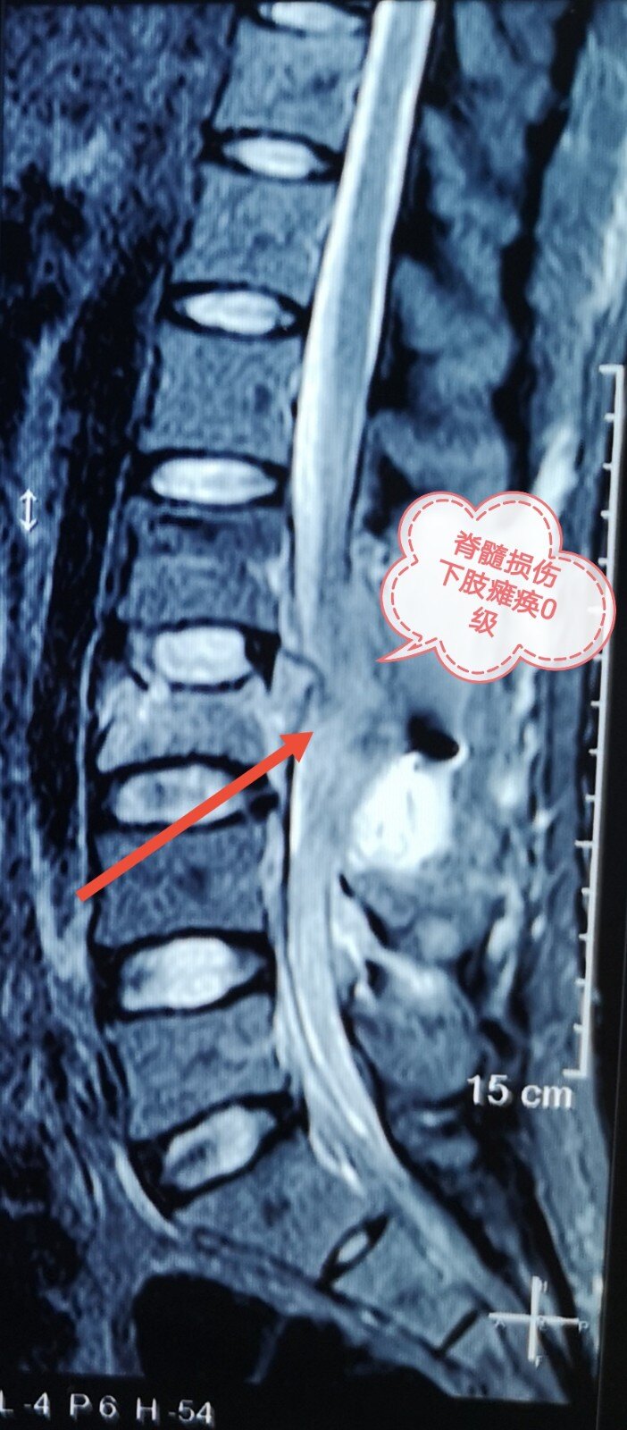 高处坠落腰椎骨折下肢瘫痪的小伙子腿脚可以活动了