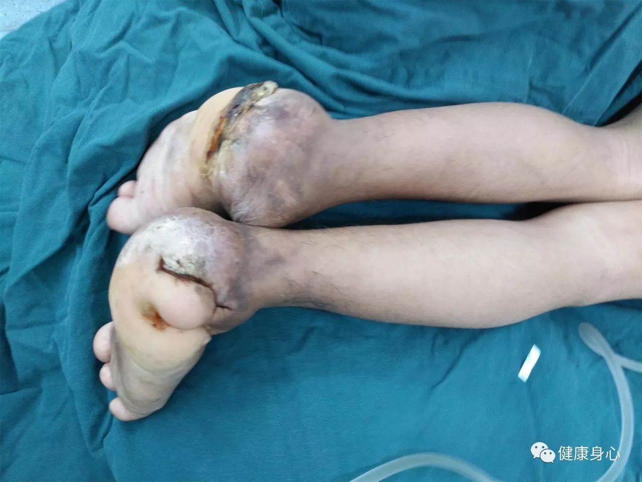 他背部鼓出来比拳头还大的一个包,里面非常硬,屁股有严重的压疮,双侧