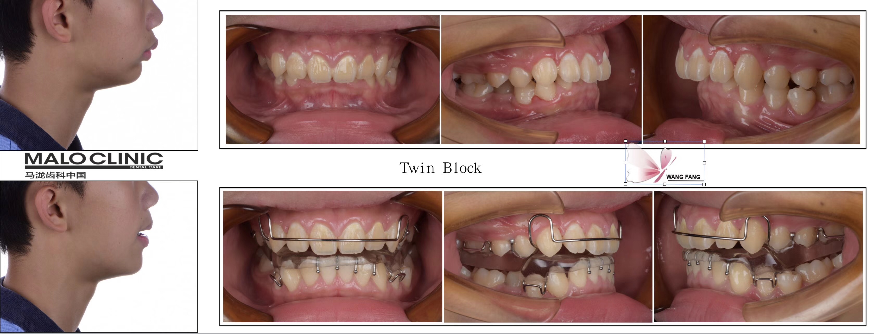 郑州牙齿矫正|下颌后缩+深覆盖+牙弓狭窄案例 - 知乎