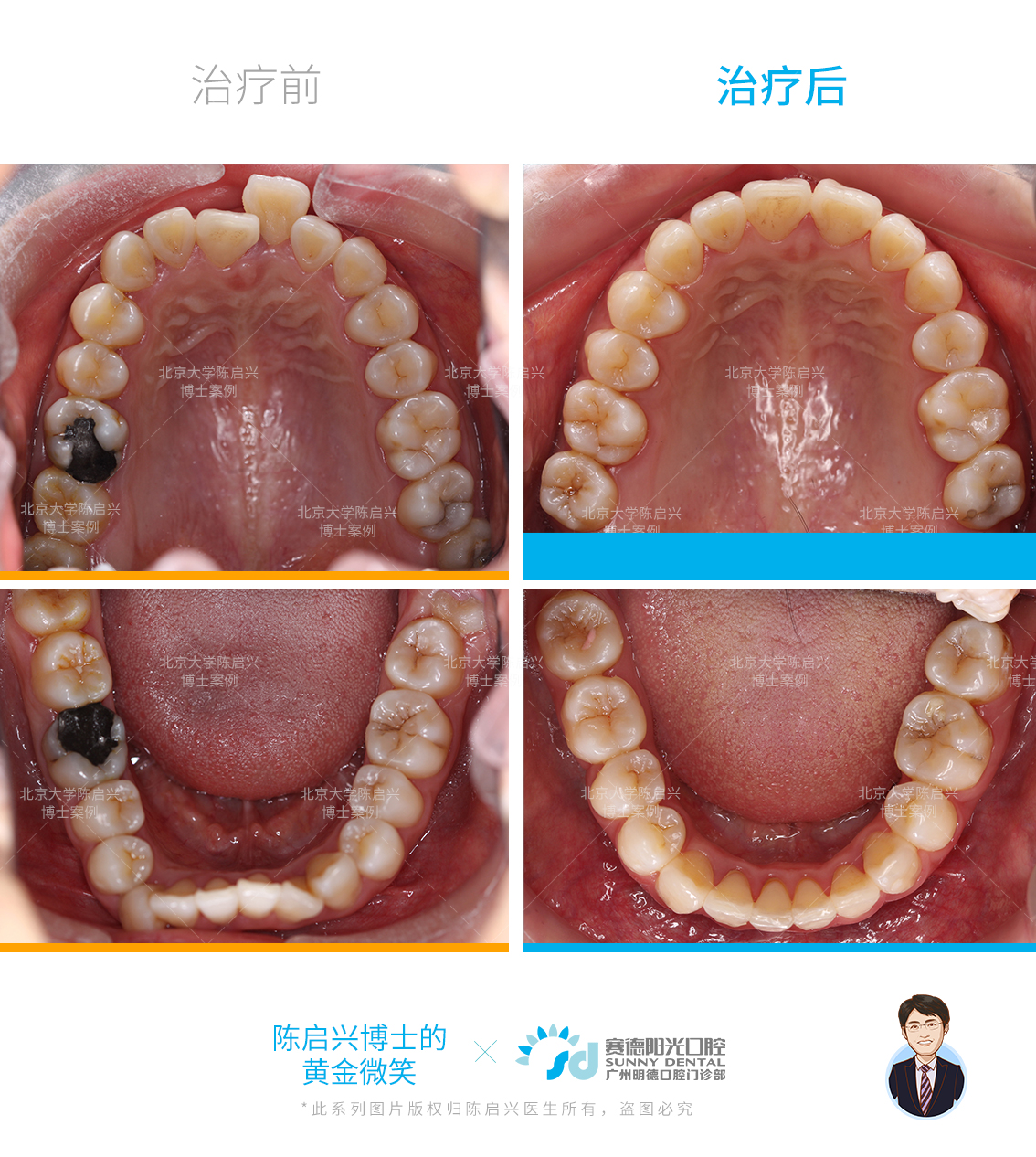 她屬於骨性嘴突,同時伴有慢性牙周炎,牙齦萎縮比較嚴重,有明顯的黑