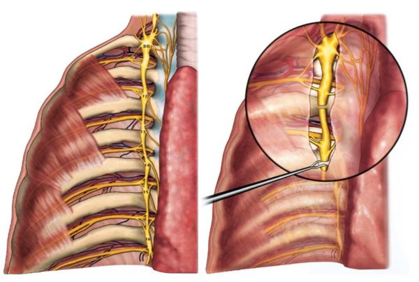 交感神经链切除术图片