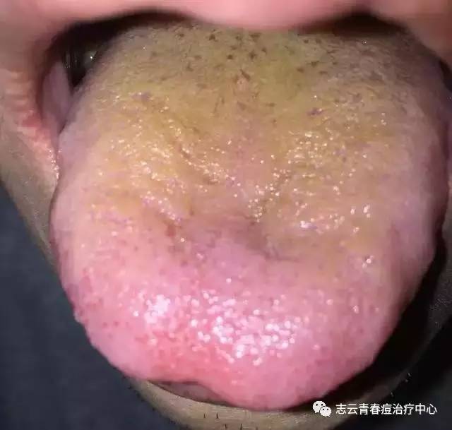 脾胃湿热型(相当于丘疹型或脓疱型)主要表现:粉刺发作频繁,可以挤出