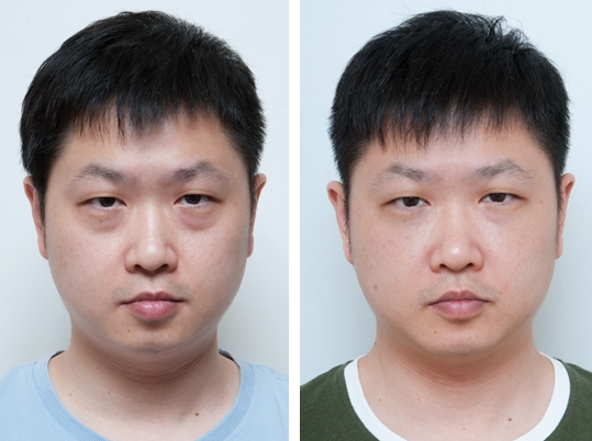 眼袋怎么解决.要看你怎么做了