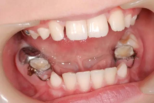 间隙保持器是什么?宝妈务必收藏!