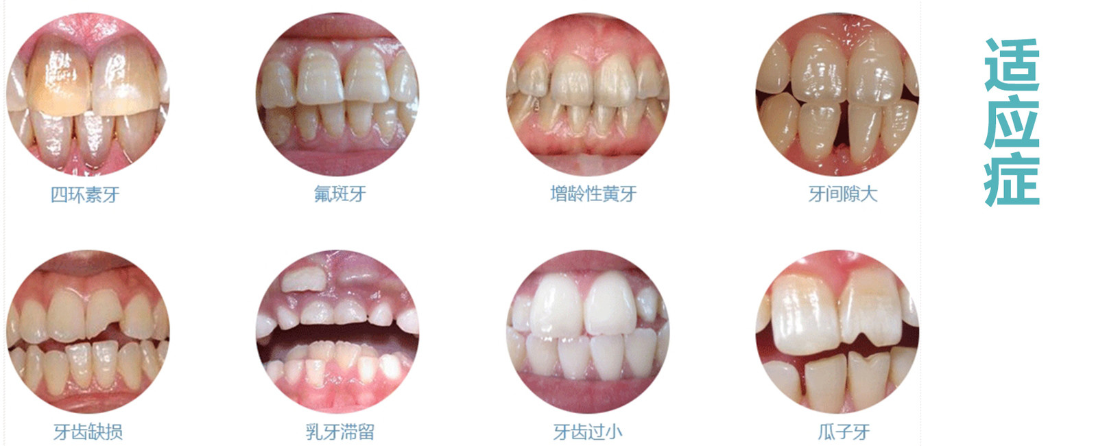 对于牙齿贴面的疑惑这篇文章可以帮你解答