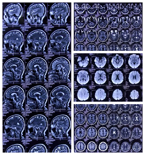 桥小脑角区表皮样囊肿图片