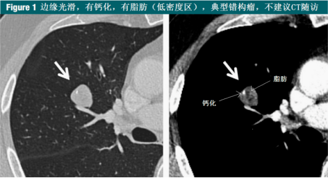 矽肺,煤工尘肺,焊工尘肺,石棉肺,滑石尘肺等等,一般为双肺多发结节