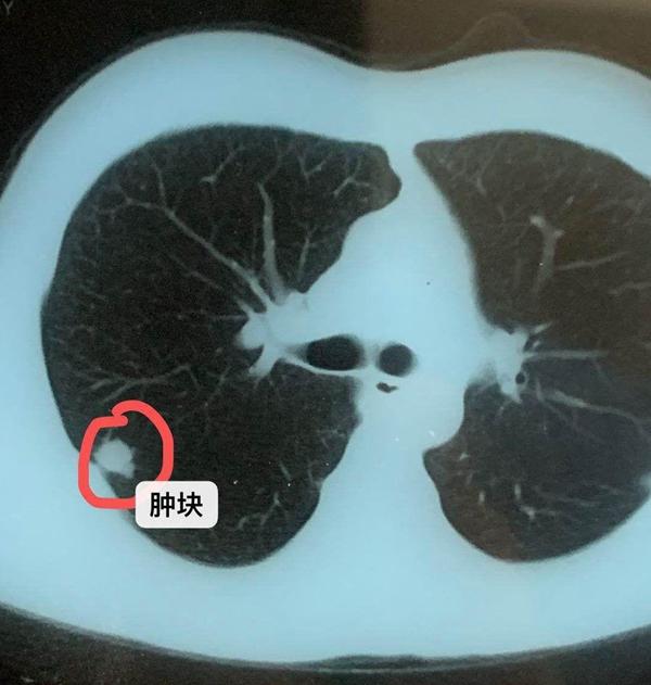 42岁王先生偶然发现右上肺肿块,病理为肺腺癌