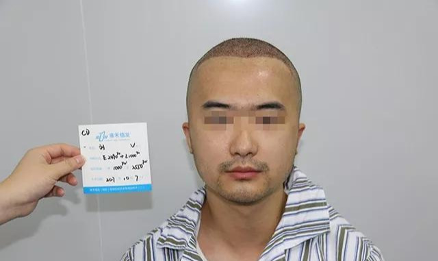 公立医院医生脱发来民营医院植发1年帅形象欢喜结婚