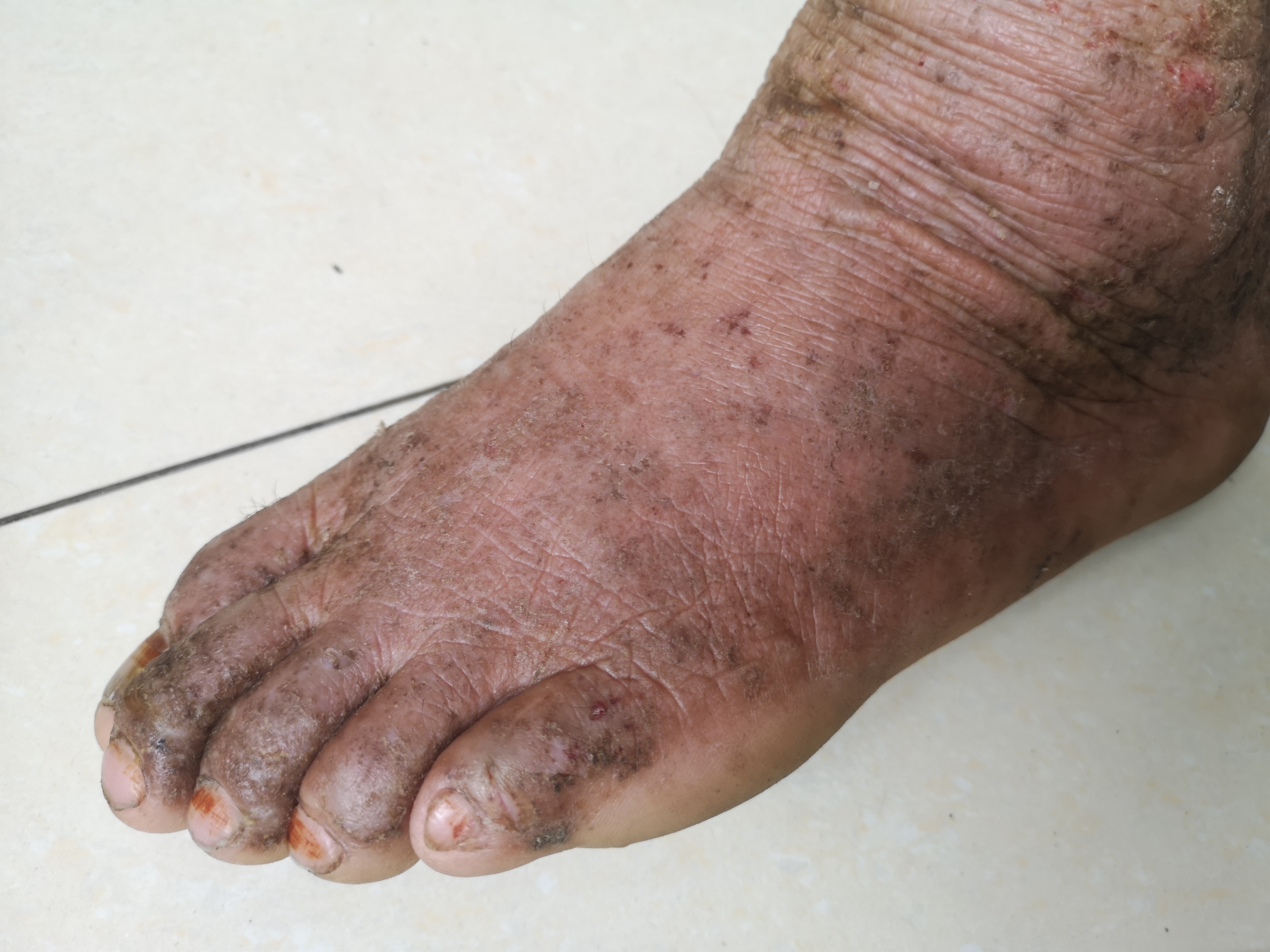 稻农皮炎—职业性接触性皮炎