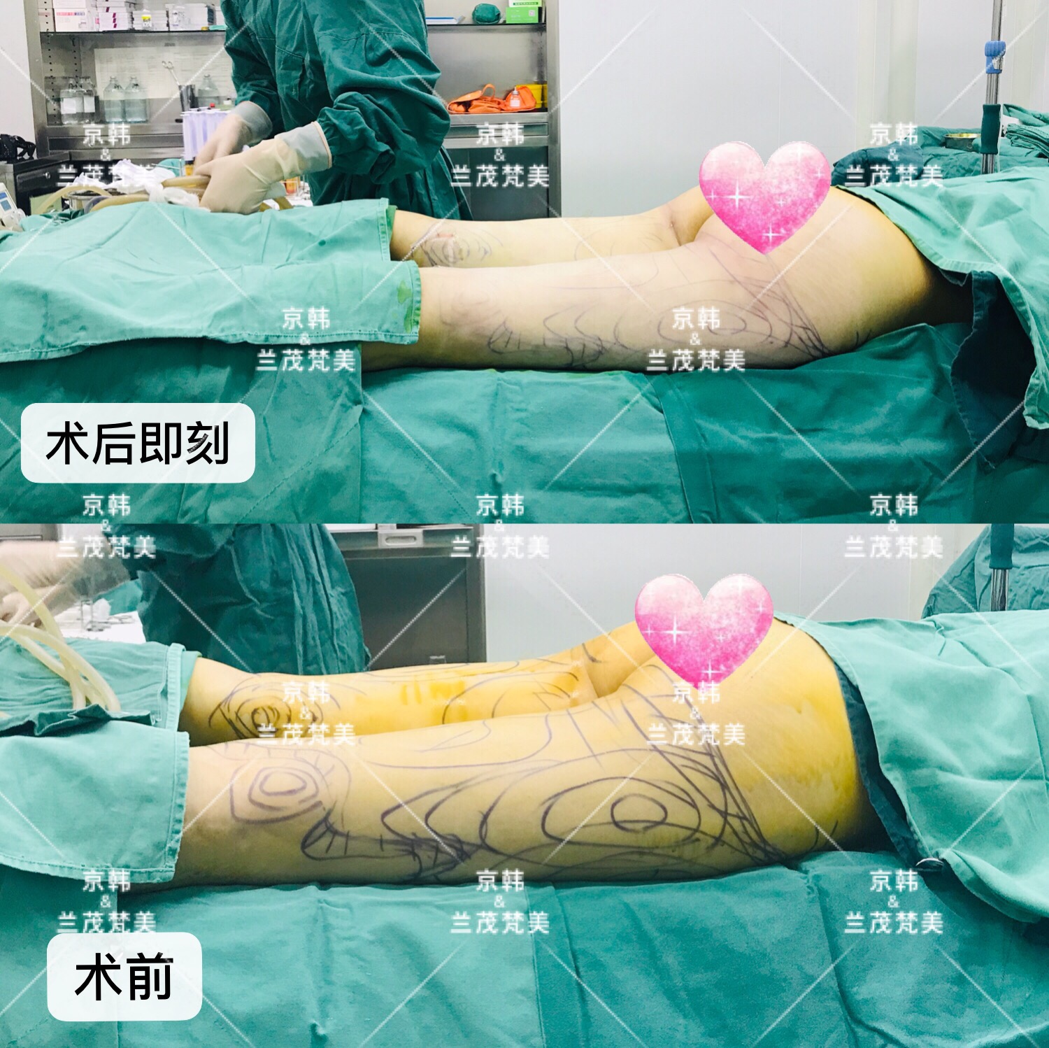 王院5—大腿环吸术后即刻2 (1).jpg