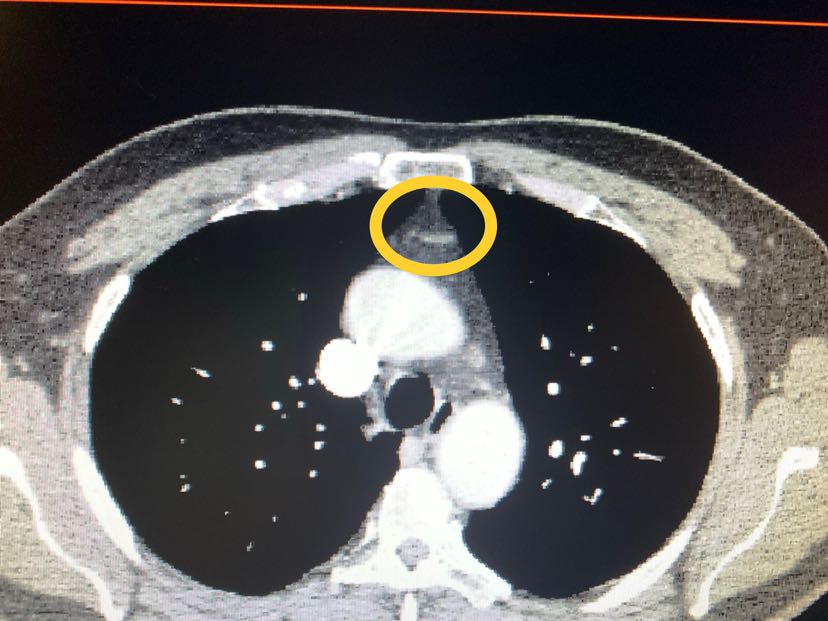 详细检查纠误诊胸腺肿瘤免开刀