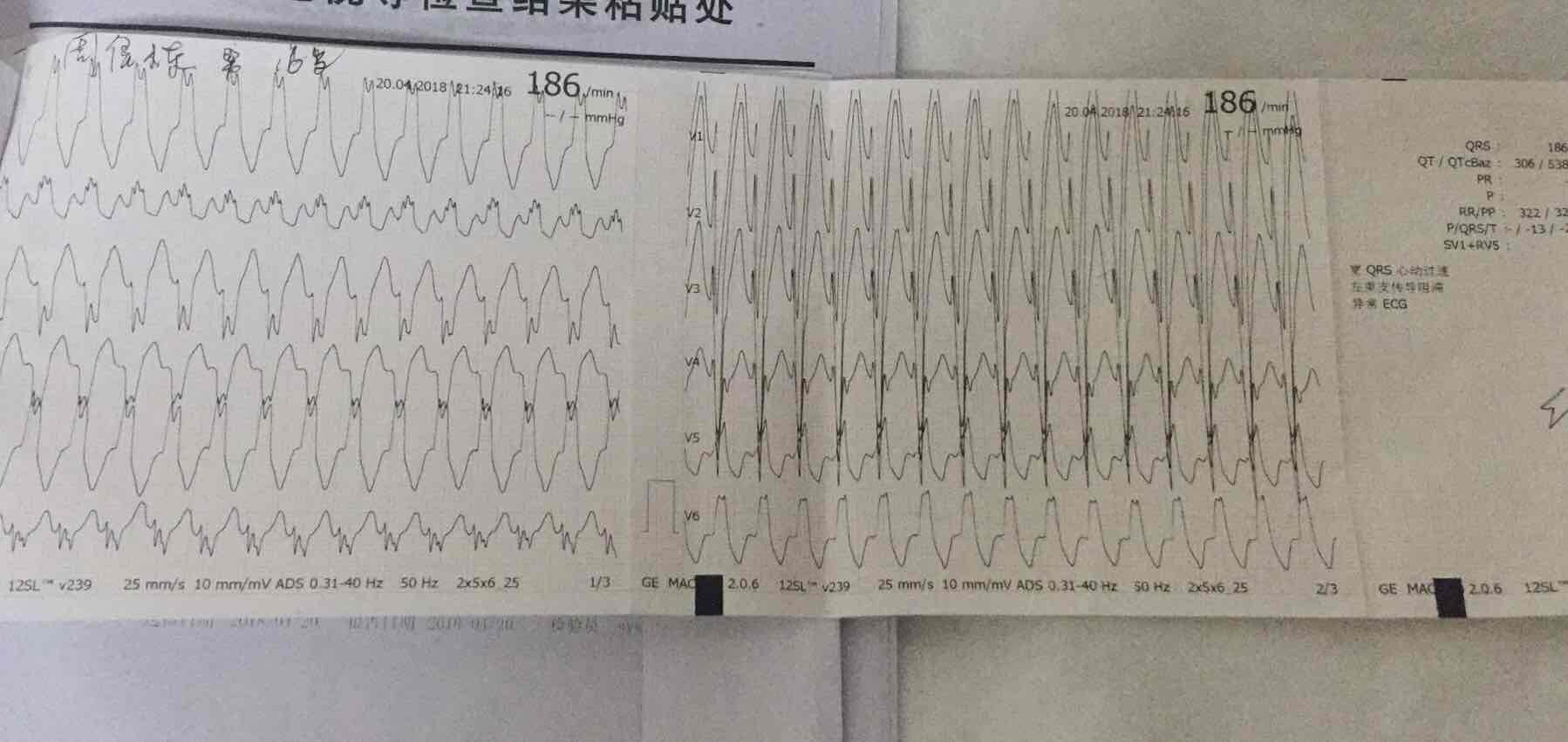 16岁少年突发快速心律失常
