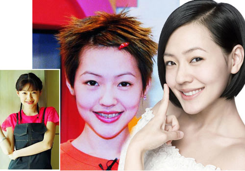 误区一:牙齿矫正真的越隐形越好目前成人牙齿矫正除了传统的钢牙套