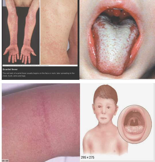 主要最特征的病变,即猩红热样皮疹一般首先从耳朵后脖子和上胸部开始